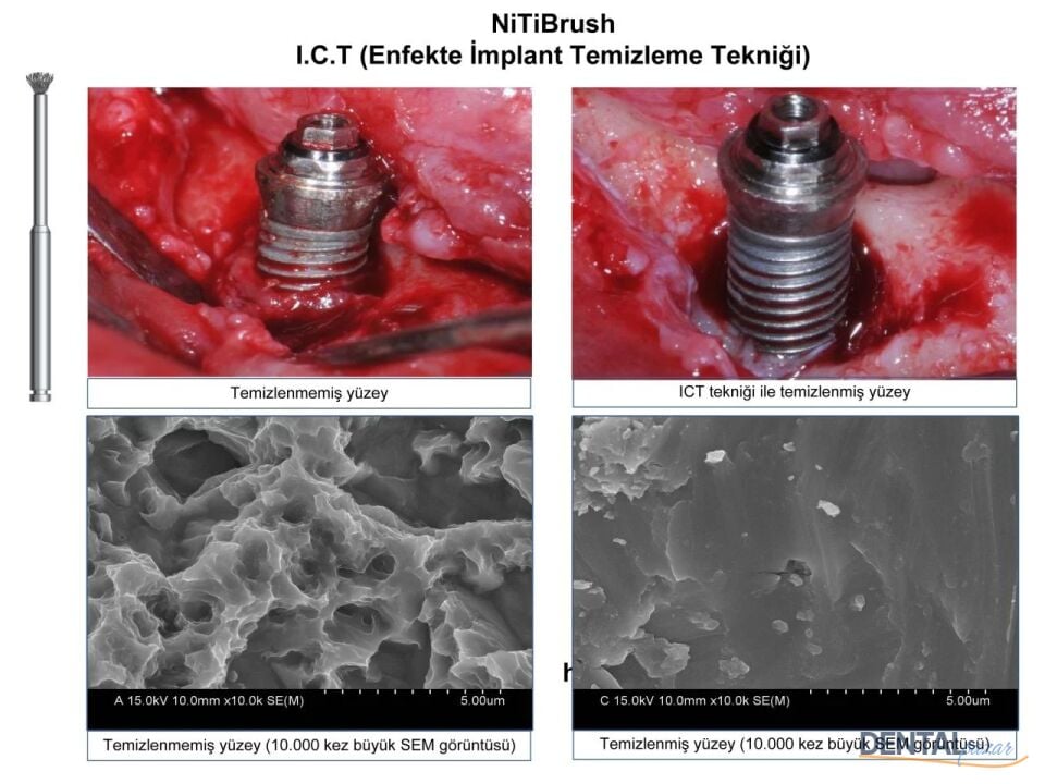 Nitibrush Peri-İmplantitis Frez Refil
