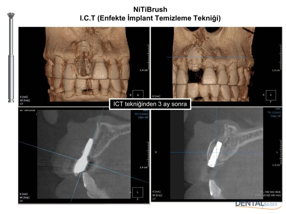 Nitibrush Peri-İmplantitis Frez Refil