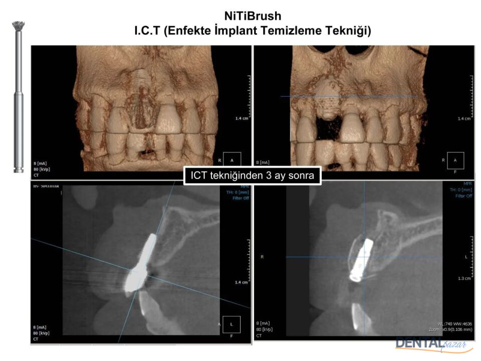 Nitibrush Peri-İmplantitis Frez Seti - 2 adet