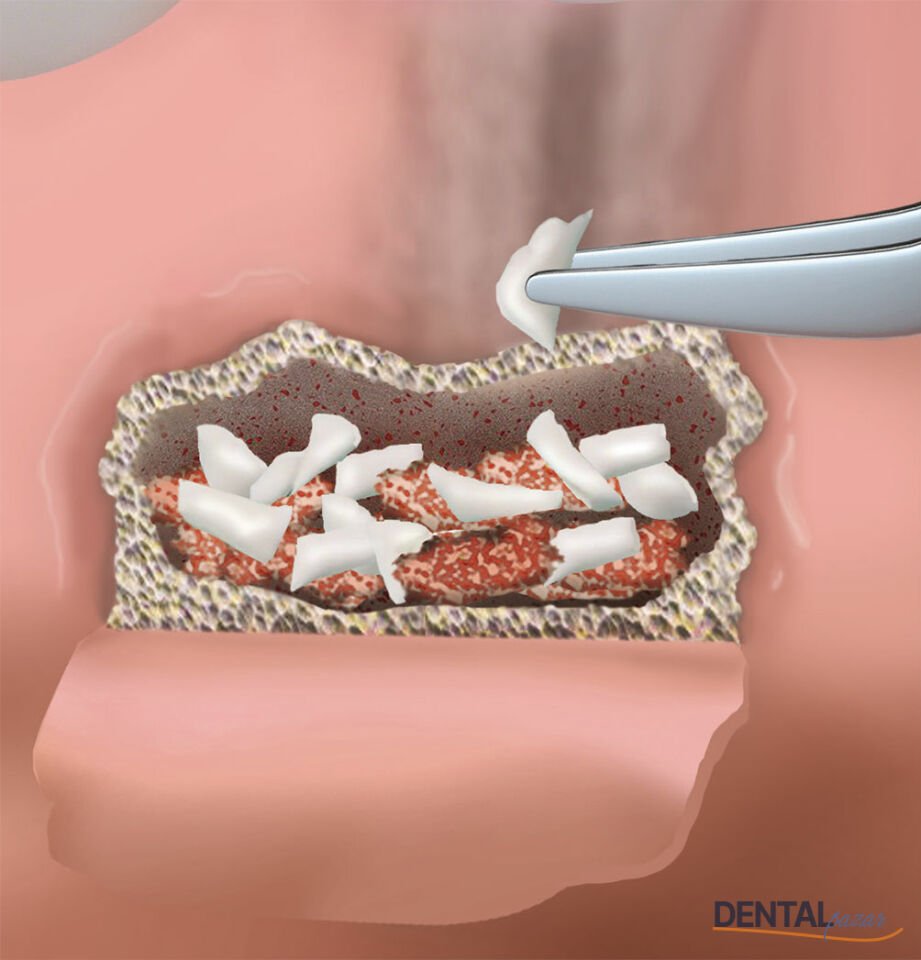 Parasorb Fleece HD Collagen Matrix Membran 70*30 mm