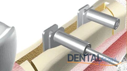 Crest Control Kemik Genişletme Bone Expander Kit
