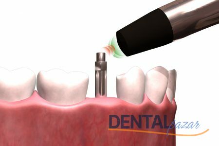 Osstell Smartpegs Osstell Uçları