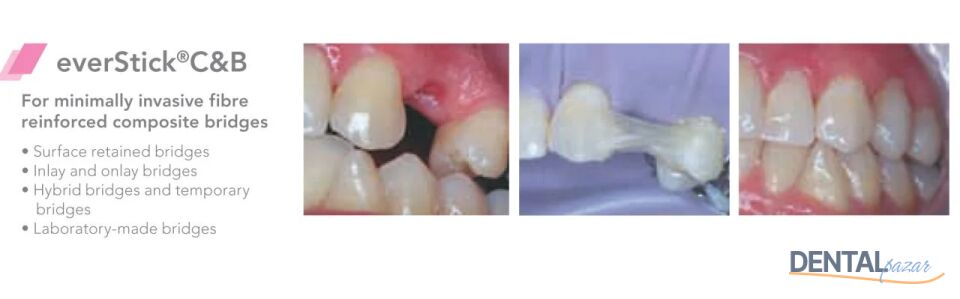 EverStick C&B 1 x 8 cm - Fiber Splint